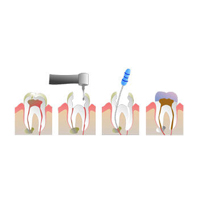 root_canal_3001